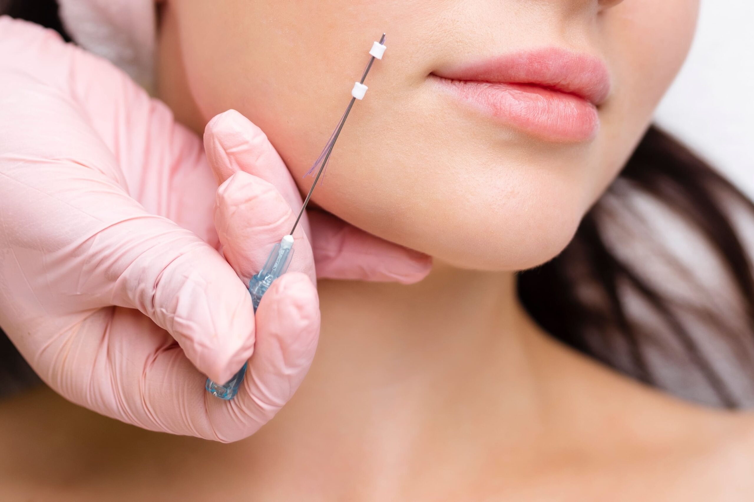 Dermatologista realizando aplicação de Fios Aptos para lifting facial sem cirurgia na Barra da Tijuca