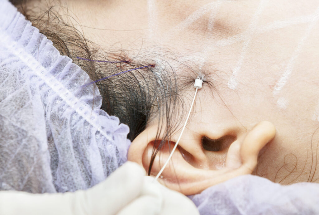 Dermatologista aplicando Fios de Pdo para flacidez no Rio
