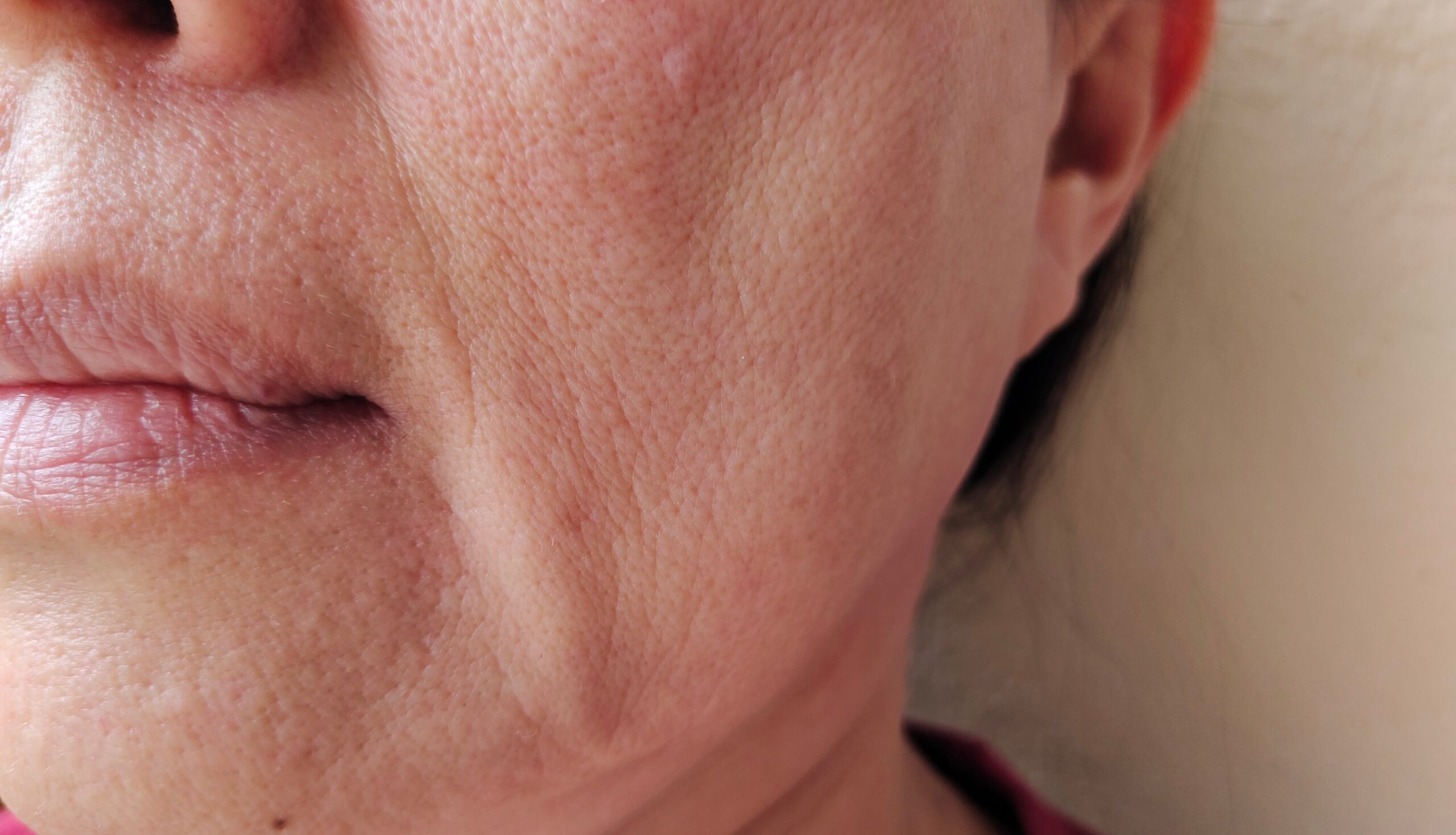 Flacidez facial com perda de definição da mandíbula e aprofundamento do sulco nasolabial