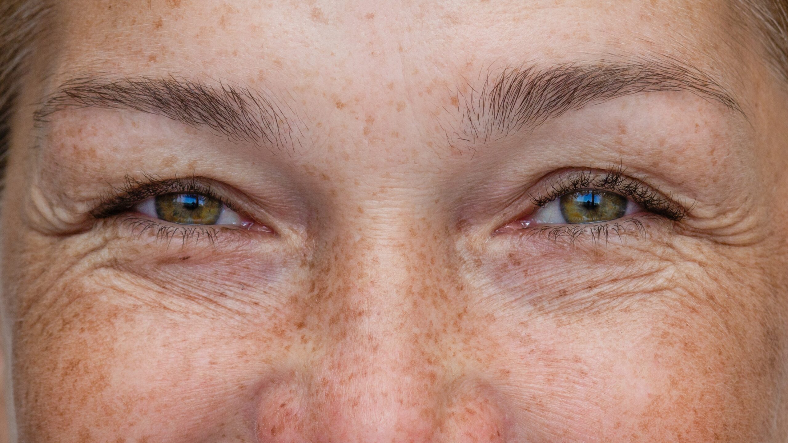 Rugas ao redor dos olhos e pés de galinha em paciente com sinais de envelhecimento da região periorbital
