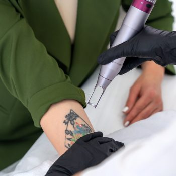 Tatuagem sendo removida com laser de picossegundos em clínica dermatológica no Rio de Janeiro