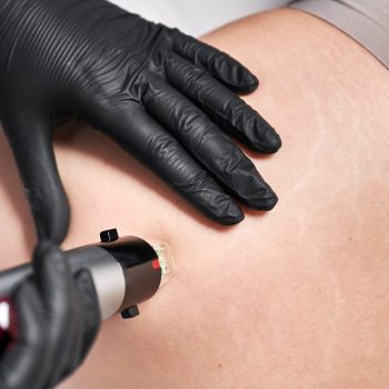 Dermatologista aplicando laser para tratamento para estrias na Barra da Tijuca, RJ