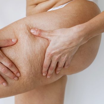 Celulite na perna tratada com tecnologia estética no Rio de Janeiro