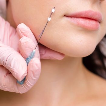 Dermatologista realizando aplicação de Fios Aptos para lifting facial sem cirurgia na Barra da Tijuca