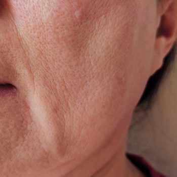 Flacidez facial com perda de definição da mandíbula e aprofundamento do sulco nasolabial