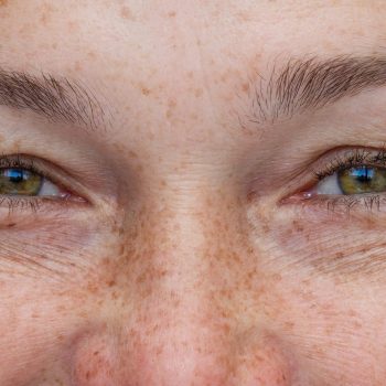 Rugas ao redor dos olhos e pés de galinha em paciente com sinais de envelhecimento da região periorbital